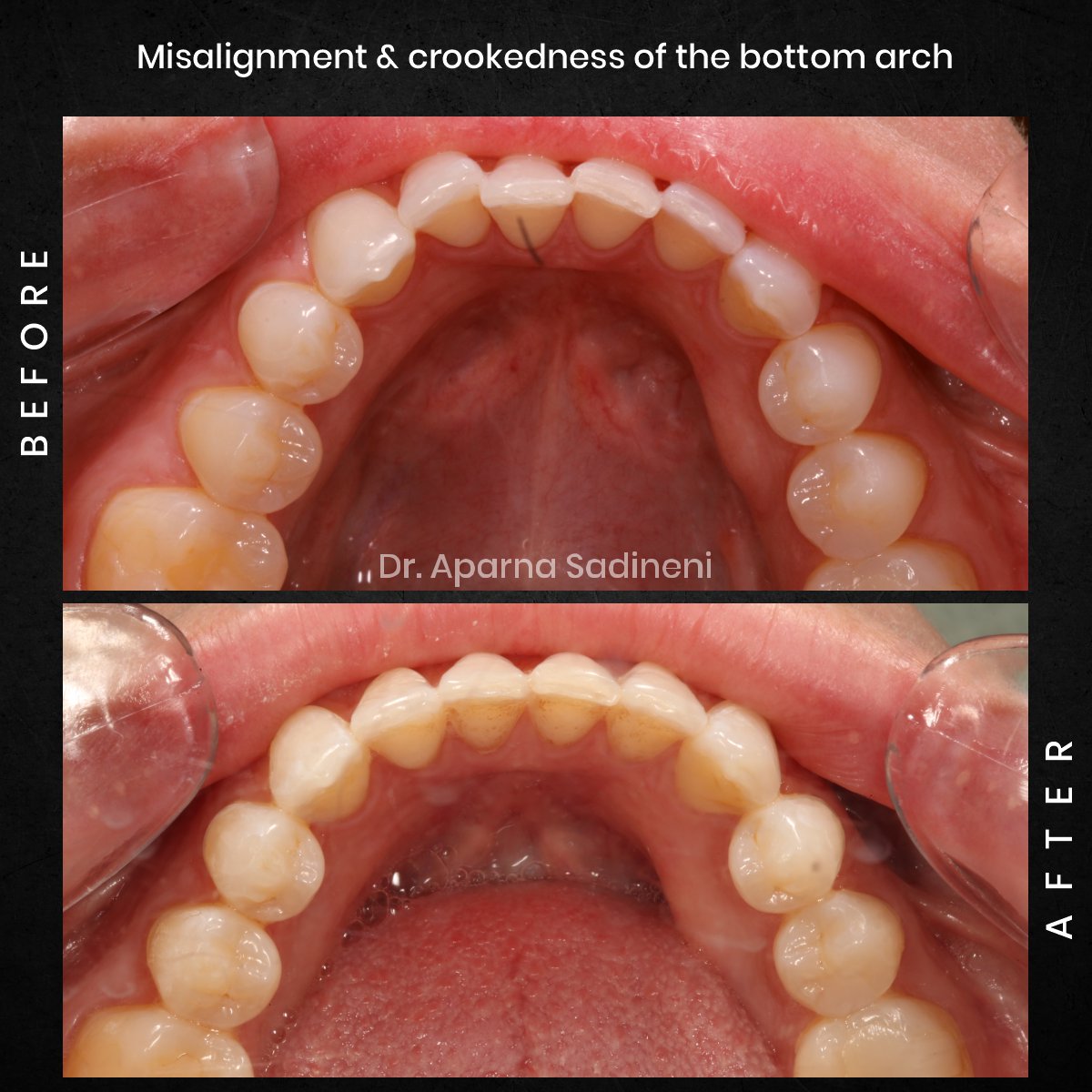 DMD DEC GRID 1 POST 1 TEETH B&A - ALICIA_4 (1)