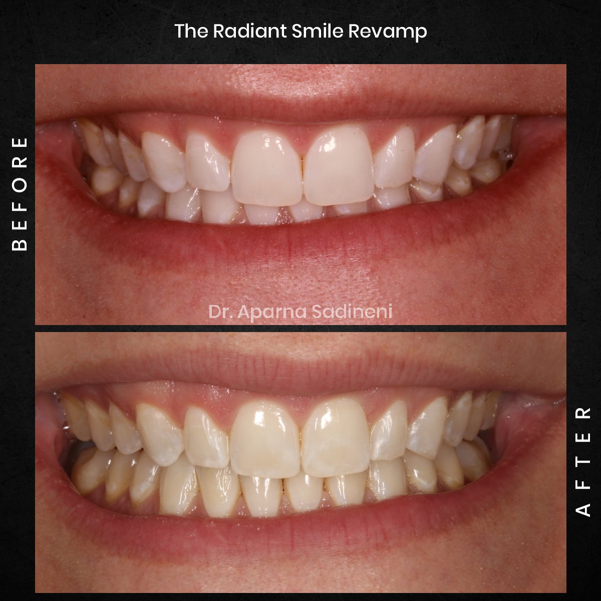 DMD DEC GRID 1 POST 1 TEETH B&A - ALICIA_5