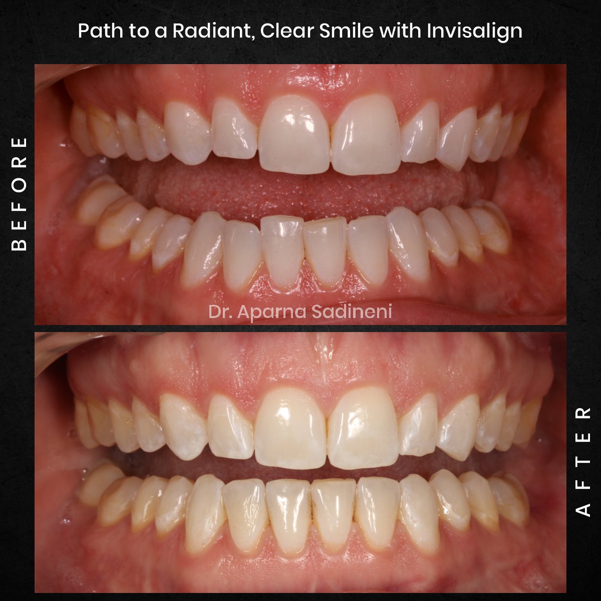 DMD DEC GRID 1 POST 1 TEETH B&A - ALICIA_8