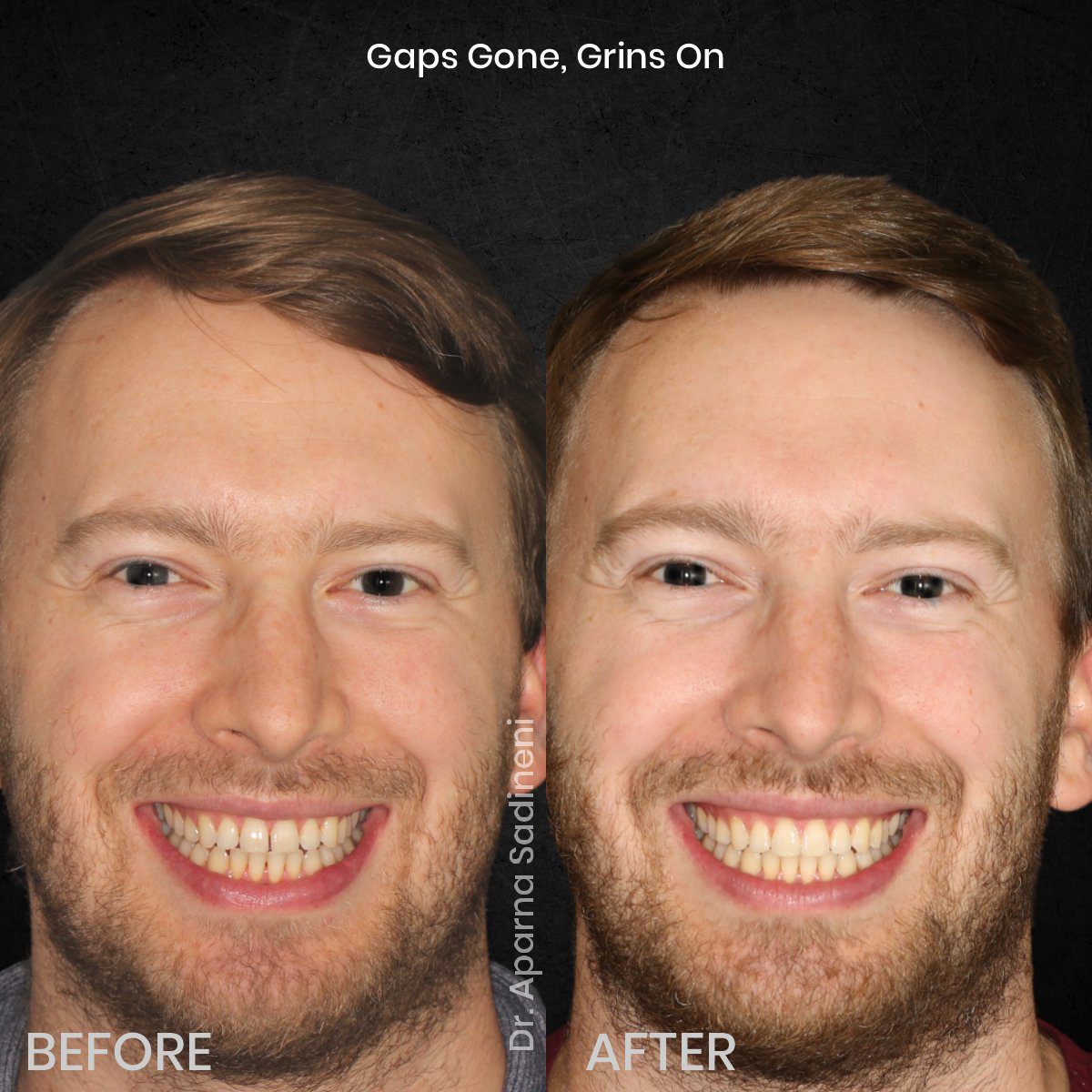DMD OCT GRID 2 POST 3 TEETH B&A - BEN C_2