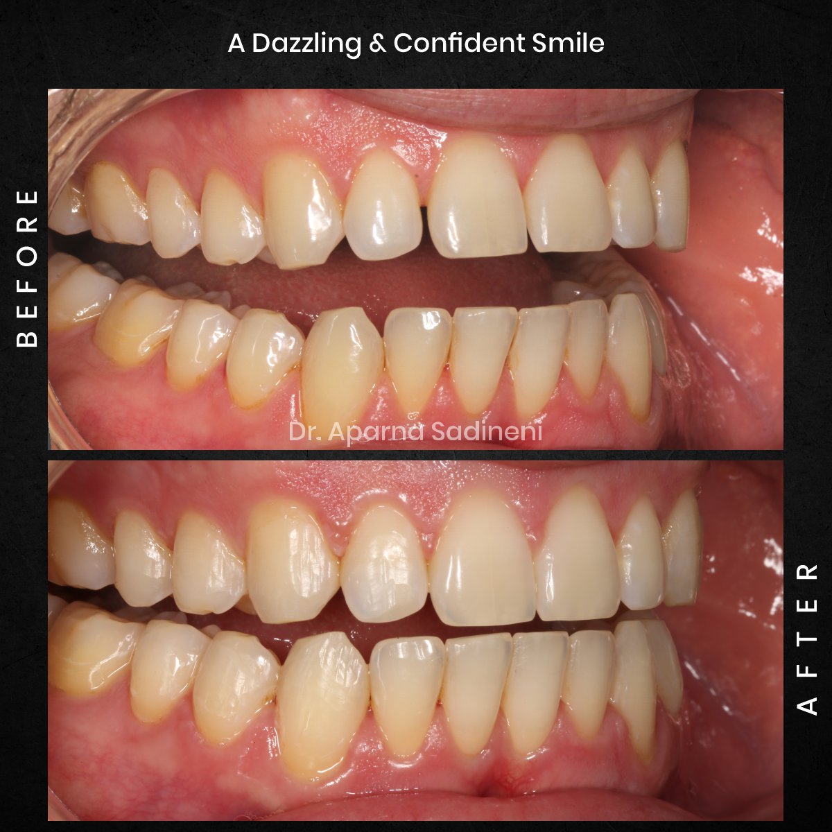 DMD OCT GRID 2 POST 3 TEETH B&A - BEN C_3
