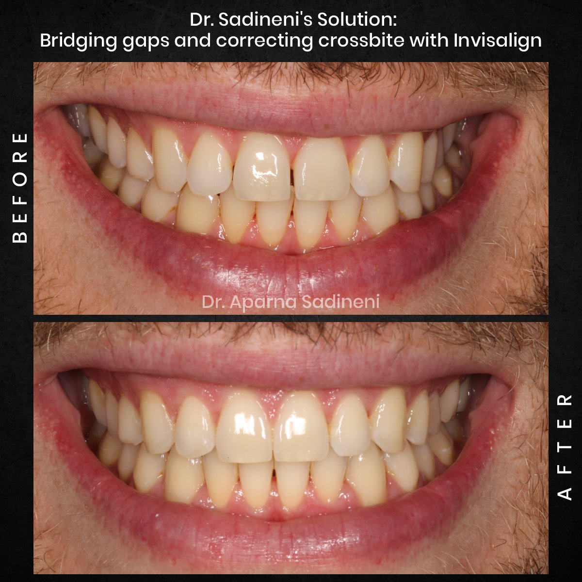 DMD OCT GRID 2 POST 3 TEETH B&A - BEN C_4