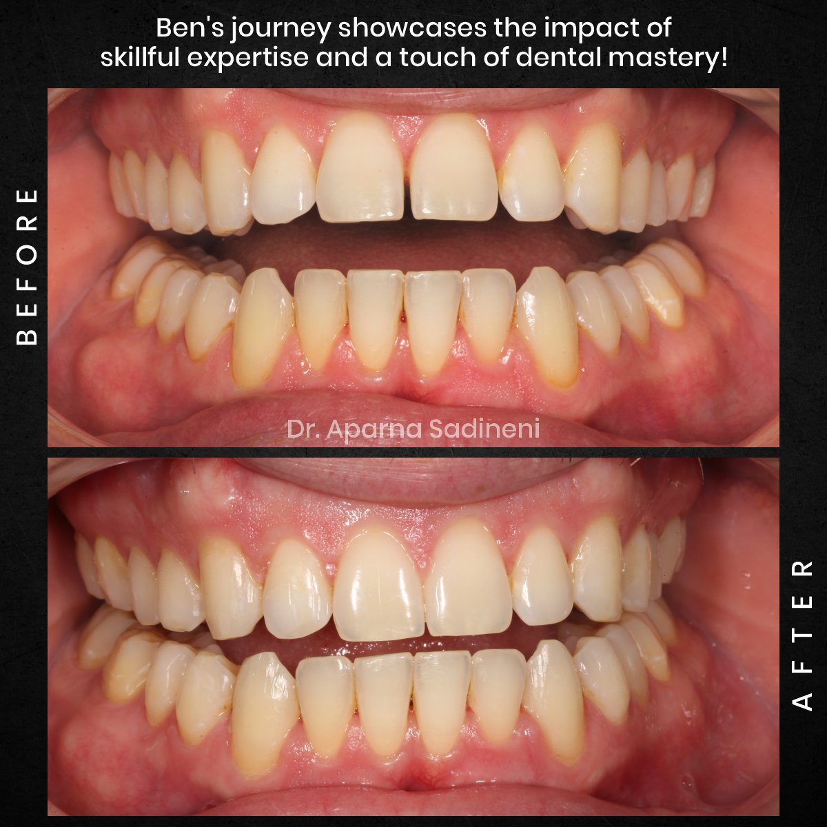 DMD OCT GRID 2 POST 3 TEETH B&A - BEN C_5