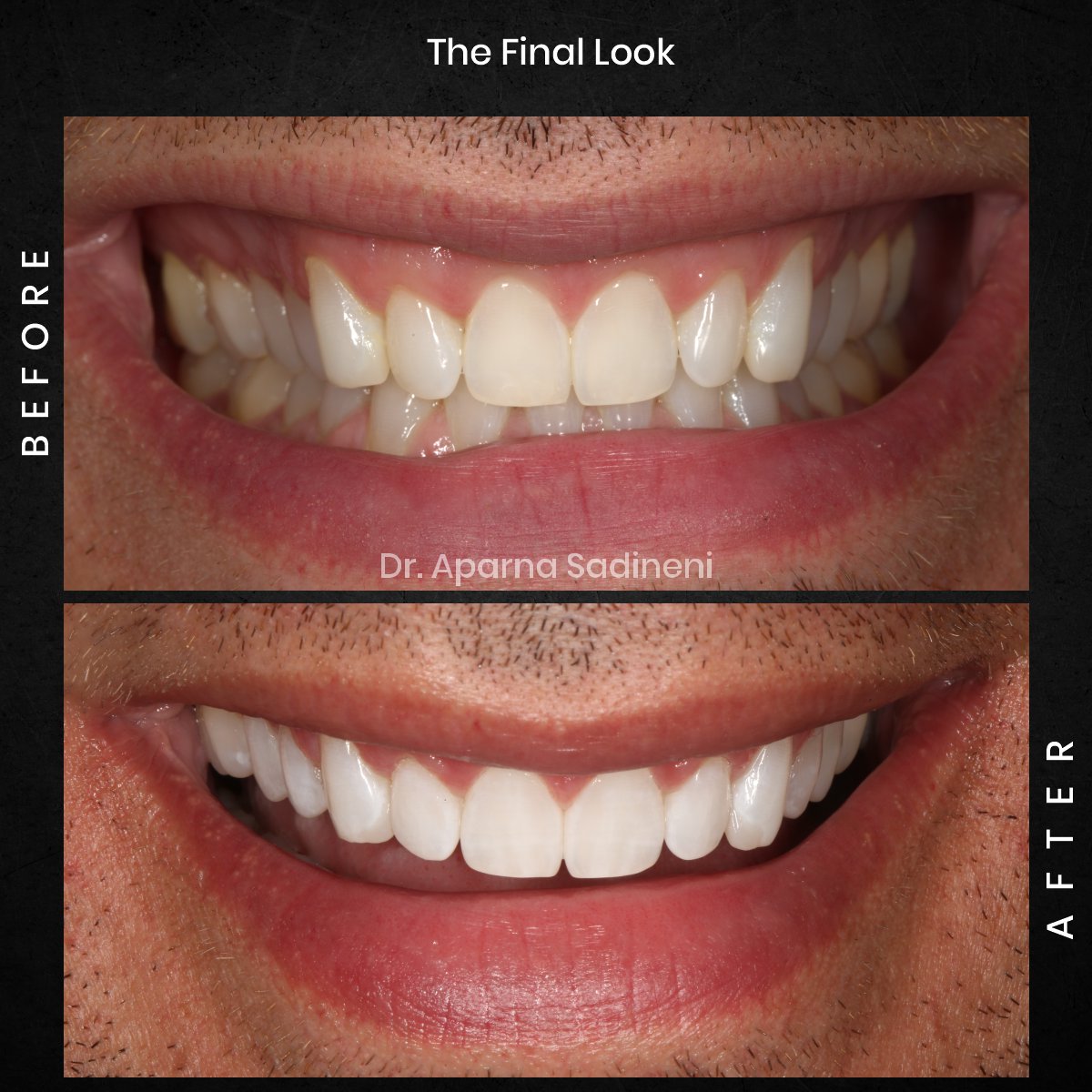DMD OCT GRID 4 B&A TEETH CAROUSEL- MICHAEL_3