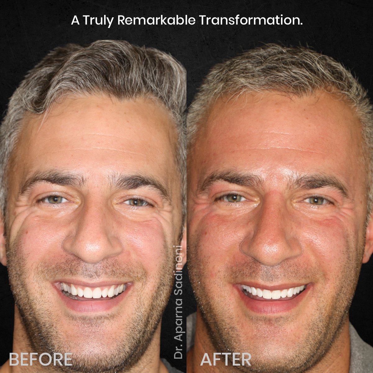 DMD OCT GRID 4 B&A TEETH CAROUSEL- MICHAEL_4