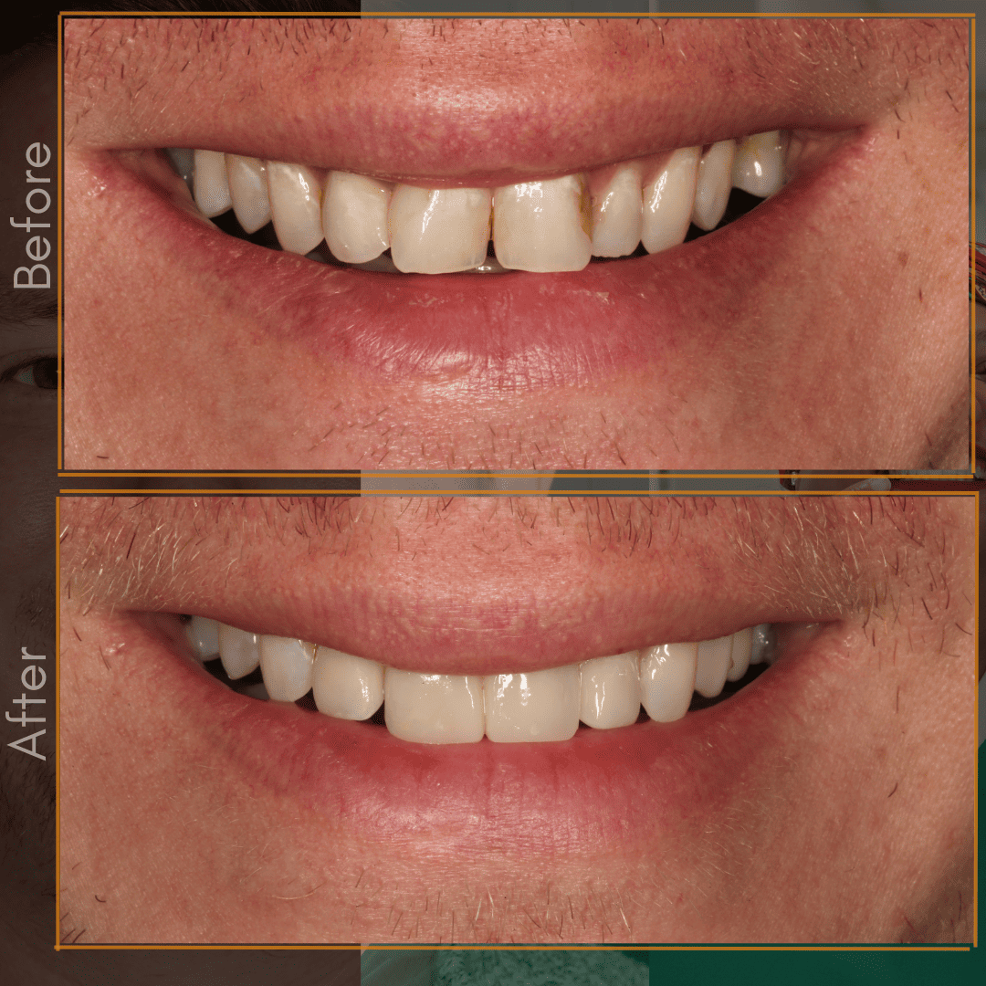 Porcelain Bridge (1)