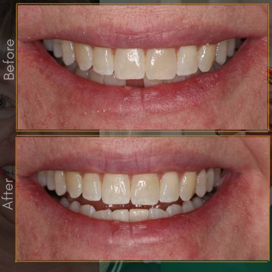 Porcelain Bridge (1)