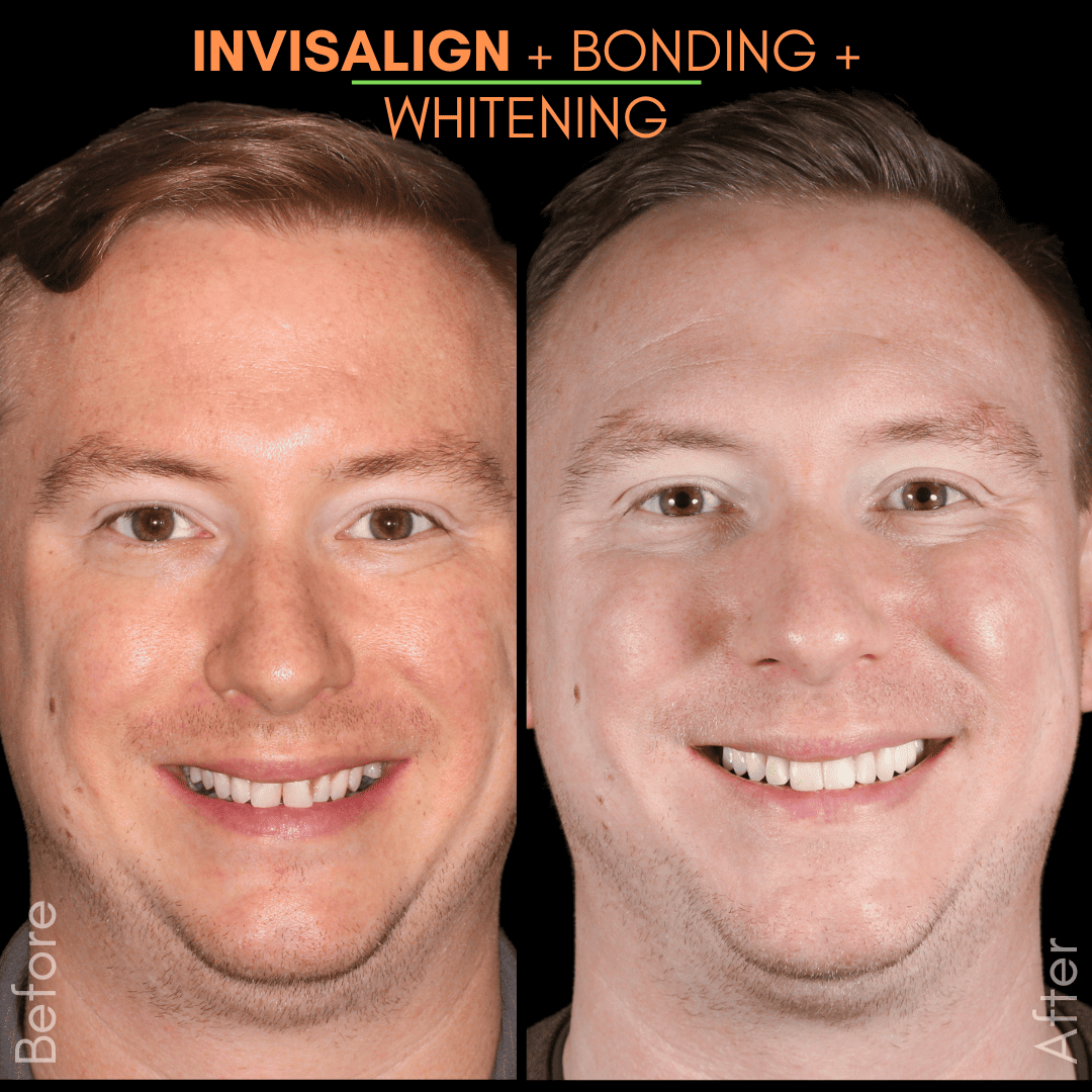 Porcelain Bridge (2)