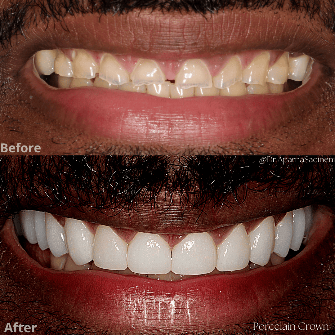 charles guess crown.png1