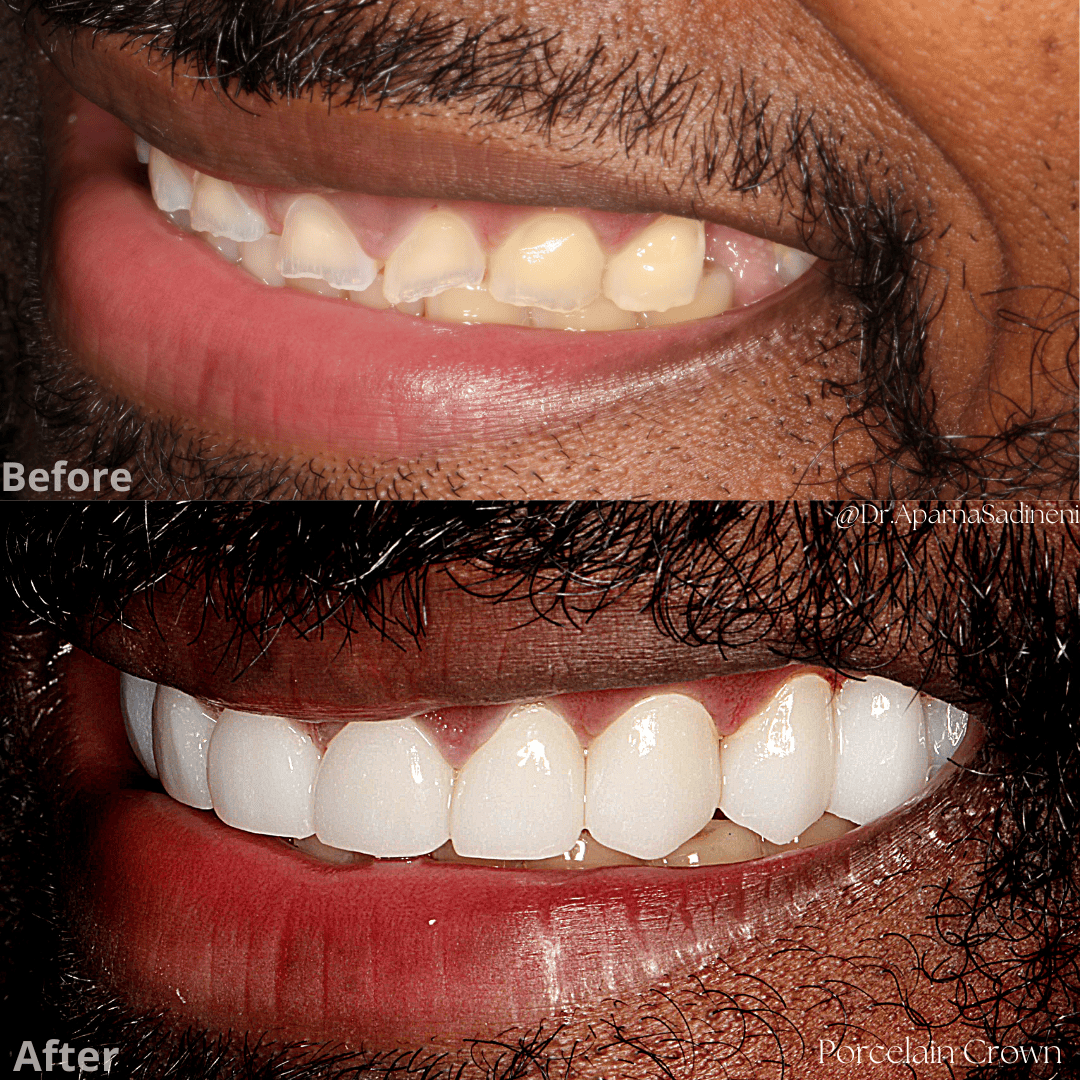 charles guess crown.png2