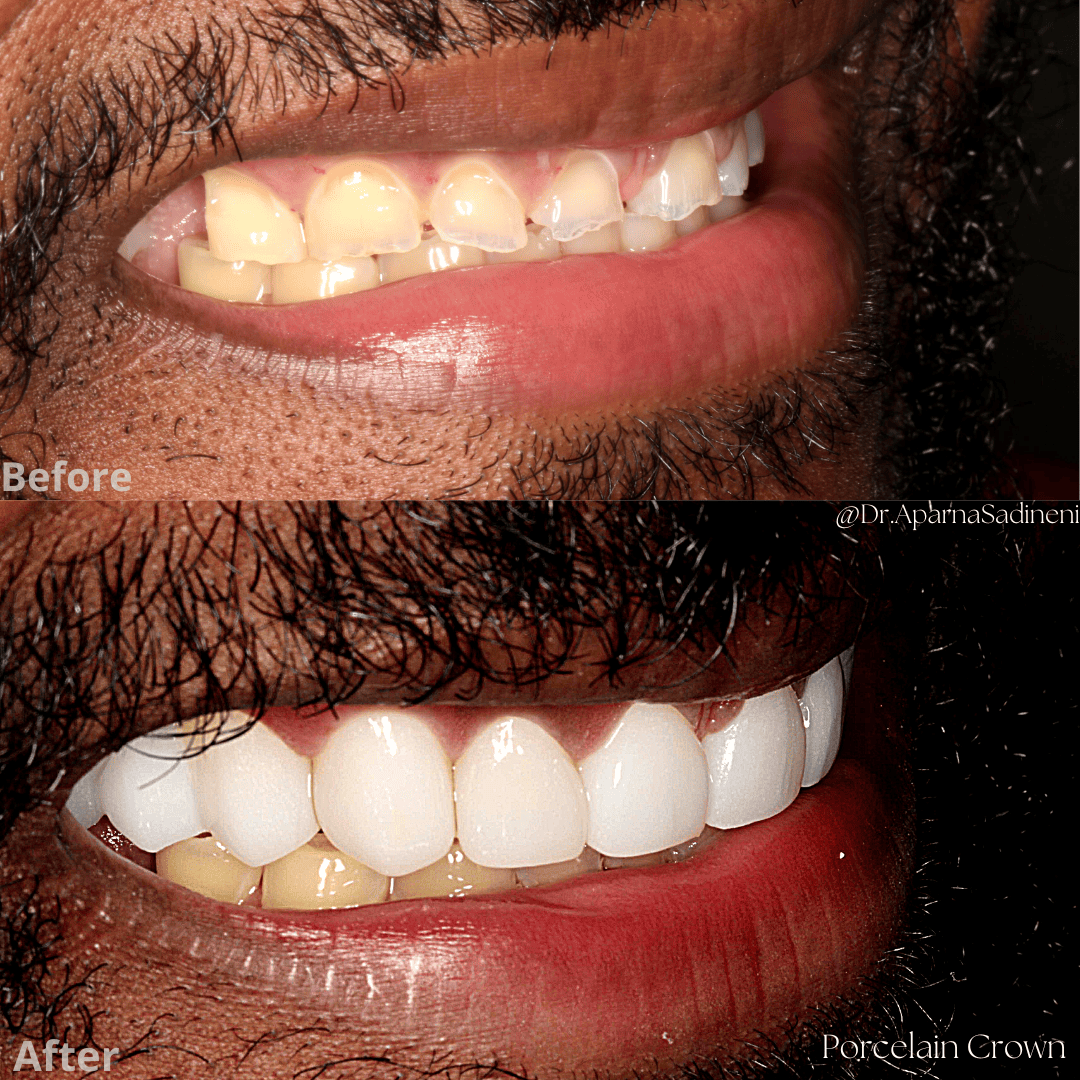 charles guess crown.png3